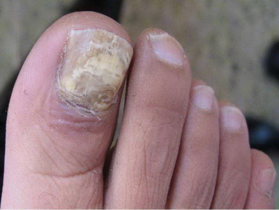 灰指甲的初期症状是怎样的